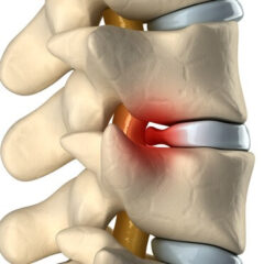 Herniated Disc